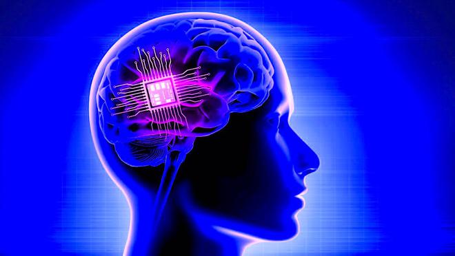 Un implant cérébral personnalisé utilisé avec succès pour le traitement de la dépression