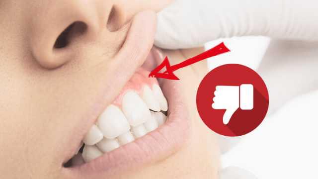 Il y a de fortes chances que votre chewing-gum soit chargé de bactéries génétiquement modifiées et vous pourrisse les dents