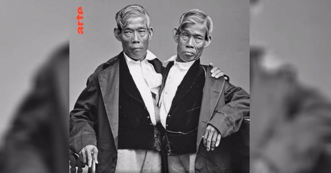 VIDÉO. Voici l’incroyable histoire des deux jumeaux à l’origine du terme « frères siamois »